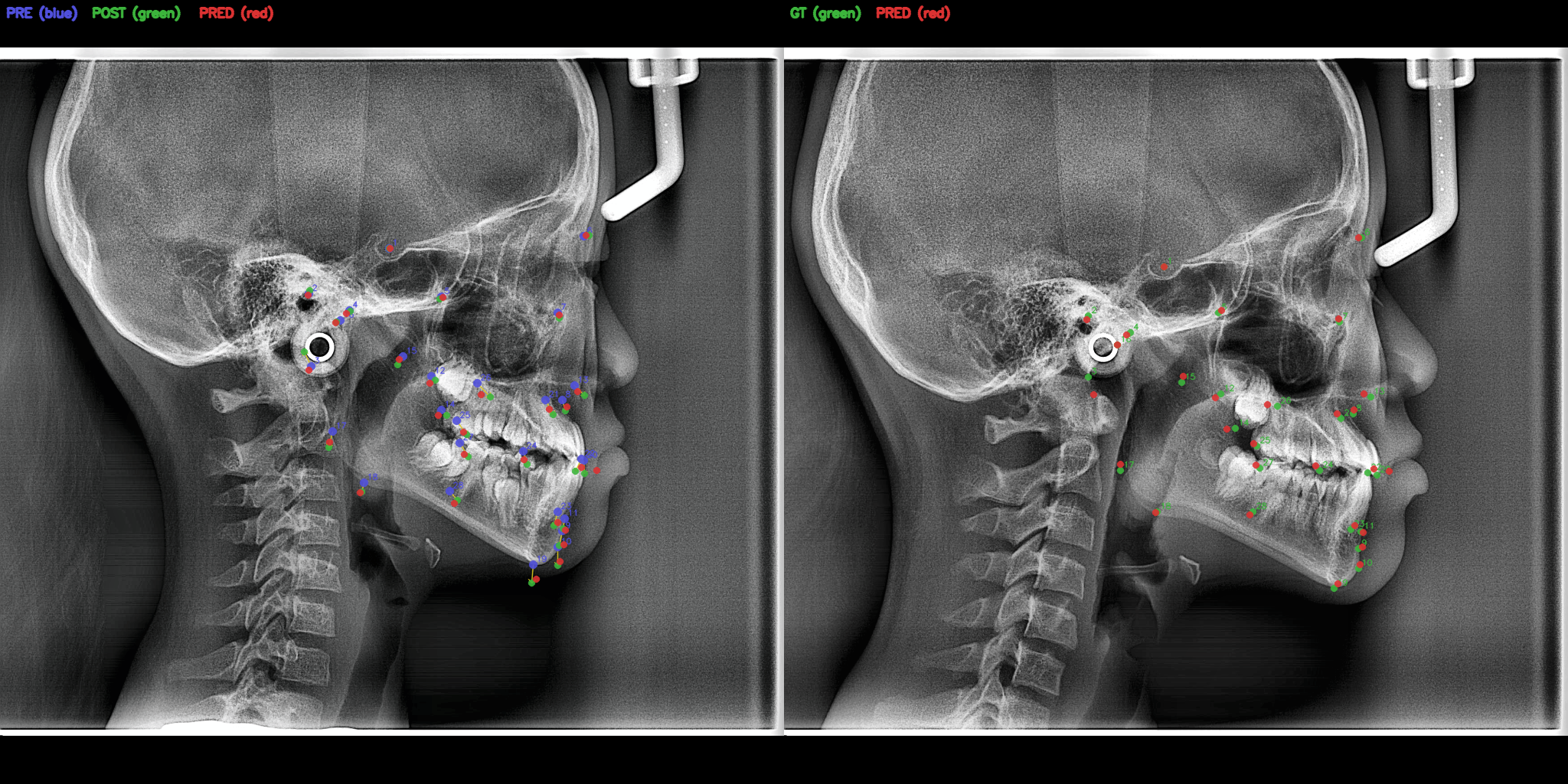 왼쪽 초기 두부계측 X-ray에 초기, 추적 관찰, AI 예측 랜드마크를 겹쳐 표시하고, 오른쪽 추적 X-ray에서 실제 관찰값과 예측값을 비교한 성장·교정치료 연구 그림. 수술 전후 결과가 아닙니다.