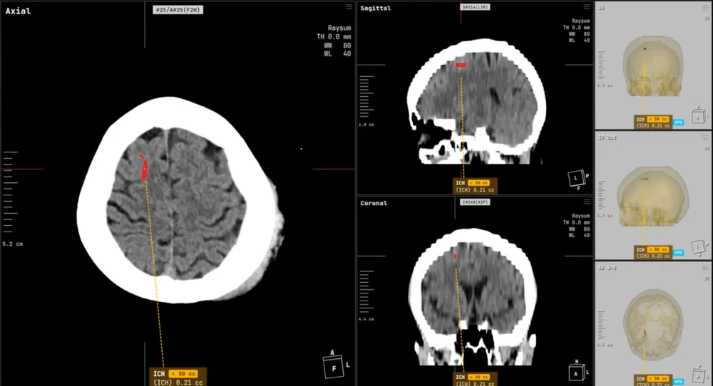 코어라인소프트 AVIEW NeuroCAD의 뇌 CT 분석 화면